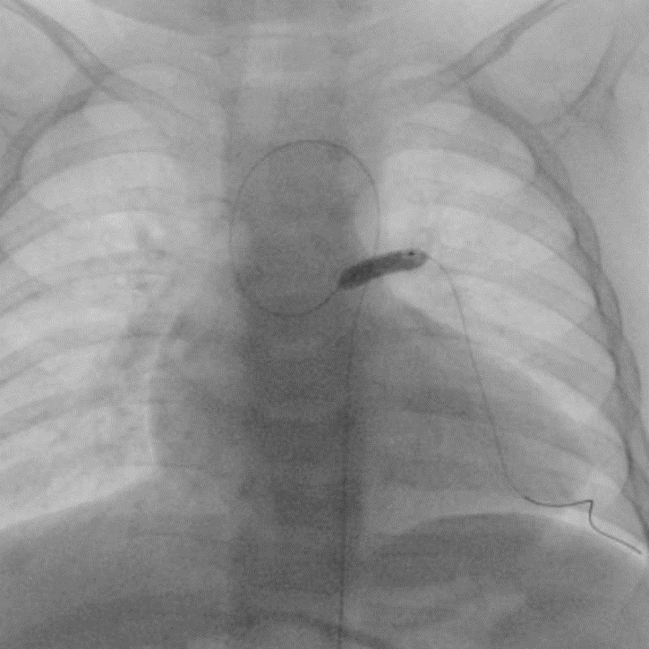 両側肺動脈絞扼術後の左肺動脈に対するバルーン拡張術